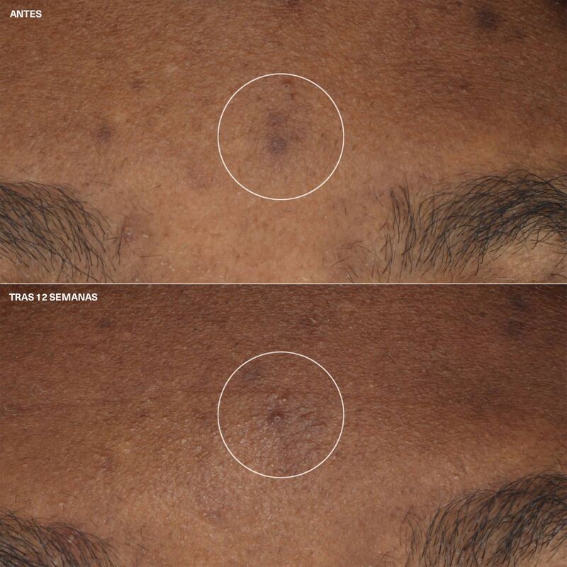 Clinique Crema Hidratante Even Better Clinical™ Antimanchas 15 ml - Farmacias Arrocha